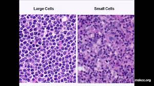 A lymphocyte is a type of white blood cell. What You Need To Know About Non Hodgkin Lymphoma Memorial Sloan Kettering Youtube