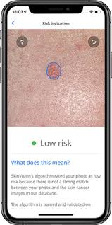 Whose identifying a potential skin cancer is not easy, and not all melanomas follow the rules. Skinvision Skin Cancer Melanoma Detection App