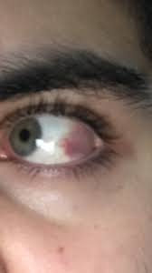 Meine Auge Ist Rot Was Ist Die Ursache Und Ist Es Schlimm Geplatzt Gesundheit Und Medizin Gesundheit Augen