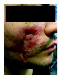 Skin lesions. (a) multiple scar-like bluish-red lesions