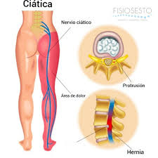 Ejercicios Ciatica Causas Y Tratamiento En Fisioterapia