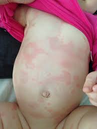 Image result for vyrážka u dětí