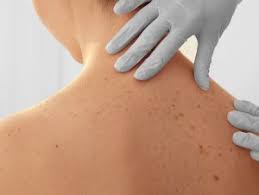 Some types of skin cancer are more dangerous than others, but if you have a spot. Skin Cancer Richmond Va