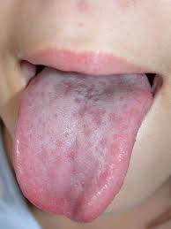 Tongue toddler mouth sores pictures. Rashes In Children What S The Diagnosis Differential Diagnoses Guidelines In Practice
