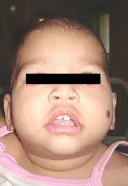 Infantile Nephrotic Syndrome with Microcephaly and Global Developmental  Delay: The Galloway Mowat Syndrome