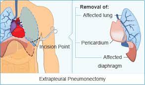Lung cancer is a leading type of cancer — and a leading killer — in the united states every year. Extrapleural Pnemonectomy In Mesothelioma Note Removed Structures Mesothelioma Cancer How To Remove