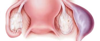 Erken evrelerde hastaların 5 yıllık yaşam şansları yaklaşık yüzde 95. Rahim Duvari Kalinlasmasi Nedir