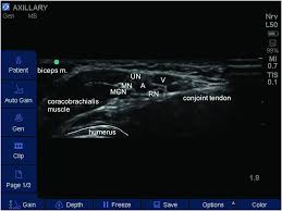 Image result for Axillary Nerve Block