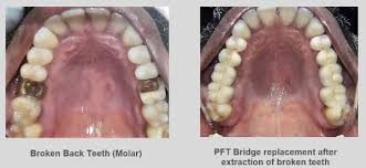 We provide the us free and free denture dentist clinic list. Zirconia Crown Dental Crowns In Chennai India Best Deal