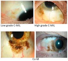 Image result for lesion sclera
