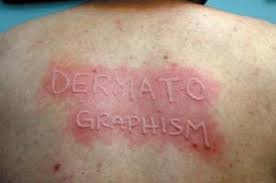 Image result for Dermatographism