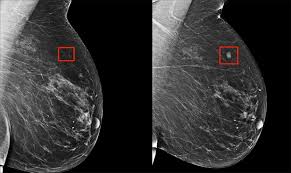 Water should be used as oral contrast material. How Ai Is Improving Cancer Diagnostics