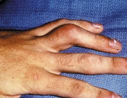 A ra causes the immune system to mistakenly attack healthy cells such as the synovium, a thin membrane that lines the joints. Quick Facts Rheumatoid Arthritis Ra Msd Manual Consumer Version