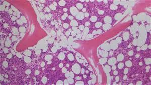 Maybe you would like to learn more about one of these? How To Read Your Bone Marrow Report Mypathologyreport Ca