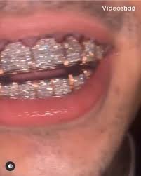 Si tiene la piel oscura o cetrina, opte por colores como el dorado, el recuerde que los brackets le pueden proporcionar un contraste entre las gomas y sus dientes, así que puede utilizar las gomas para matizar el color de su. Do You Really Want To Overpay Video Teeth Jewelry Grills Teeth Grillz