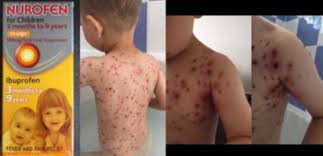 Il est indiqué, chez l'adulte et l'enfant de plus de 30 kg (soit environ ne prenez jamais ibuprofene mylan conseil 400 mg, comprimé pelliculé : Pourquoi L Ibuprofene Est A Bannir En Cas De Varicelle Ou De Toute Infection Virale Sciences Et Avenir