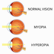 Astigmatism And Its Importance In Eye Surgery Loden