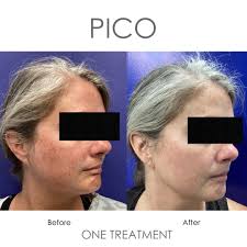 👀 Look at these results after just one treatment! 😮 Pico laser technology  is a non-surgical, non-invasive laser skin treatment that can be used to  address the majority of common skin imperfections,