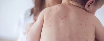Hy, doc, saya ingin bertanya, mengapa badan saya semua berada di tempat yang berwarna merah, apa alergi yang anda ada, udara mengepung? Timbulnya Bintik Merah Pada Kulit Bayi Nutriclub