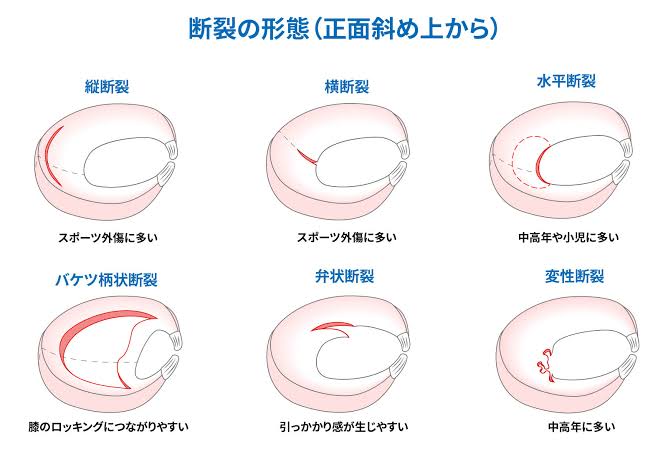 半月板損傷とは｜スポーツによる発生リスク・症状と予防｜ジャーナル（サポーター）｜ザムスト公式オンラインショップ【ZAMST Online】