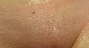 Louis specializing in laser hair removal, wrinkle relaxers, prp skin therapy and more. Laser Hair Removal St Louis Permanent Hair Reduction Missouri