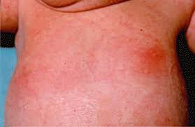 Image result for Hyperthelia