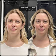 Scar Specialist • Aesthetician (@complexionsbyjadeengler) • Instagram  photos and videos