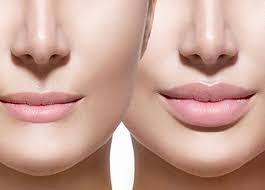 This hyaluronic acid pen filler has been widely used and recommended by many as a cost effective way compared to botox injections! Hyaluron Pen Needle Free Injections Bella Beauty