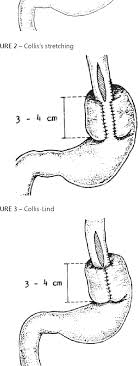 Pdf Collis Gastroplasty Associated To Parcial Or Total Fundoplication Experimental Study Gastroplastia A Collis Associada A Fundoplicatura Parcial Ou Total Estudo Experimental Semantic Scholar