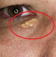 Petua hilangkan biji kolestrol bawah mata for more information and source, see on this link : Cara Hilangkan Biji Kolestrol Atau Buang Biji Kolestrol Facebook