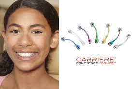 Forums pour discuter de carrière, voir ses formes composées, des exemples et poser vos questions. Carriere Motion Appliance Orthodontic Technology Eagle Orthodontics