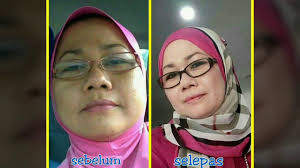 Flavettes should be given with care to patients with underlying renal failure due to the risk of formation of renal oxalate calculi. Pengobatan Dan Khasiat Herbal Khasiat Flavettes Vitamin C 1000mg