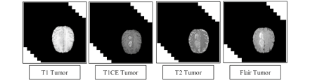 Malignant brain tumors usually seem to develop when cancer from some other part of the body spreads to the brain. Sample Mri Scans To Represent The Multiclass Brain Tumor Classification Download Scientific Diagram