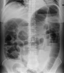 Image result for Adynamic Ileus