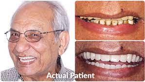 The cost of dental implants in canada. All On 4 Dental Implants For Missing Teeth Studio B Dental