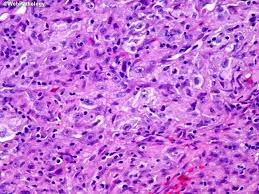 Mesothelioma histology is a way to describe the cancer by the types of cells involved. Webpathology Com A Collection Of Surgical Pathology Images