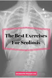 The Best Exercises For Scoliosis Scoliosis Exercises Scoliosis Yoga For Scoliosis