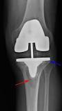 Image result for what treatment is given to repair cement loosening in a knee replacement
