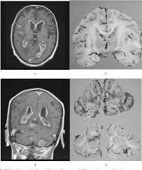 Malignant pleural mesothelioma means it is cancerous and will spread. Pdf Gamma Knife Radiosurgery Of Brain Metastasis From Malignant Pleural Mesothelioma Report Of Three Cases With Autopsy Study In A Case Semantic Scholar
