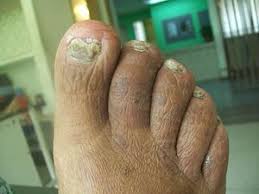 Image result for Koilonychia feet