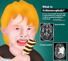 What Is Schizencephaly Epilepsy Quotes Brain Tissue Muscle Tone