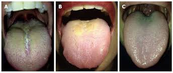Image result for black hairy tongue symptoms