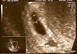 Erkennt man einen embryo also als teil der frau an, kann man den konflikt zwischen dem lebensrecht des ungeborenen und dem selbstbestimmungsrecht der. Schwangerschaft 6 Woche 6 Ssw Ultraschallbilder