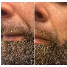 Image result for Beard Dermatitis