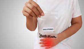 Gallstones are often discovered during tests for a different condition, as they often don't cause any symptoms. How To Roll Out Gallstones Using Homeopathy Dr Batra S