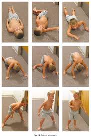 Image result for Μυϊκή Δυστροφία Ντουσέν