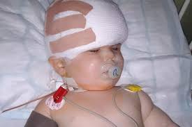 Toddler with rare condition has skull broken apart and pieced back together  like jigsaw