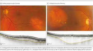 Image result for nevus sclerae