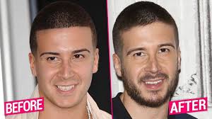 Jersey shore is a reality television series that aired on mtv. Jersey Shore Cast S Shocking Plastic Surgery Transformations Revealed