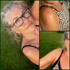 Unintentional shrugging after shoulder surgery?